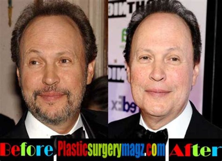Billy Crystal Facelift Plastic Surgery Before and After