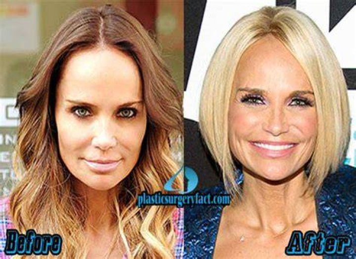 Kristin Chenoweth Plastic Surgery Before and After Botox Injections